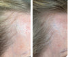 Trudermal Halo LED Hair Growth System